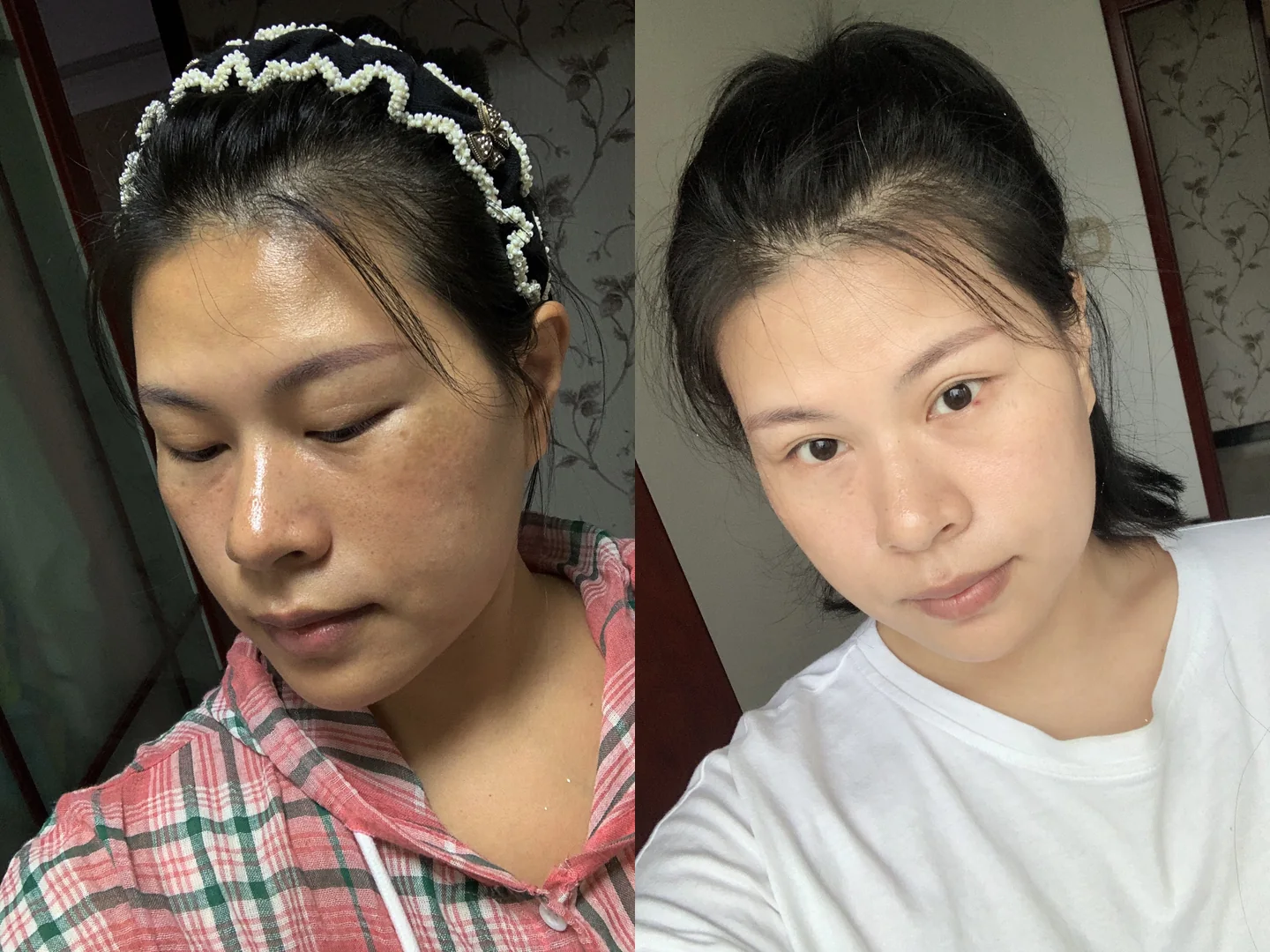 Pigmentation before and after reference for Pico Laser treatment