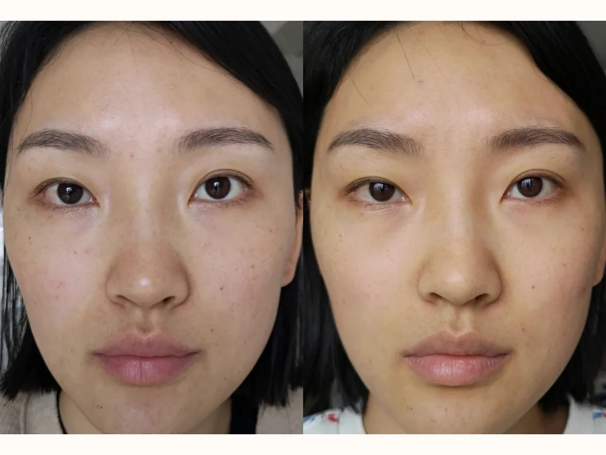 Pico Laser pigmentation before and after reference case 2