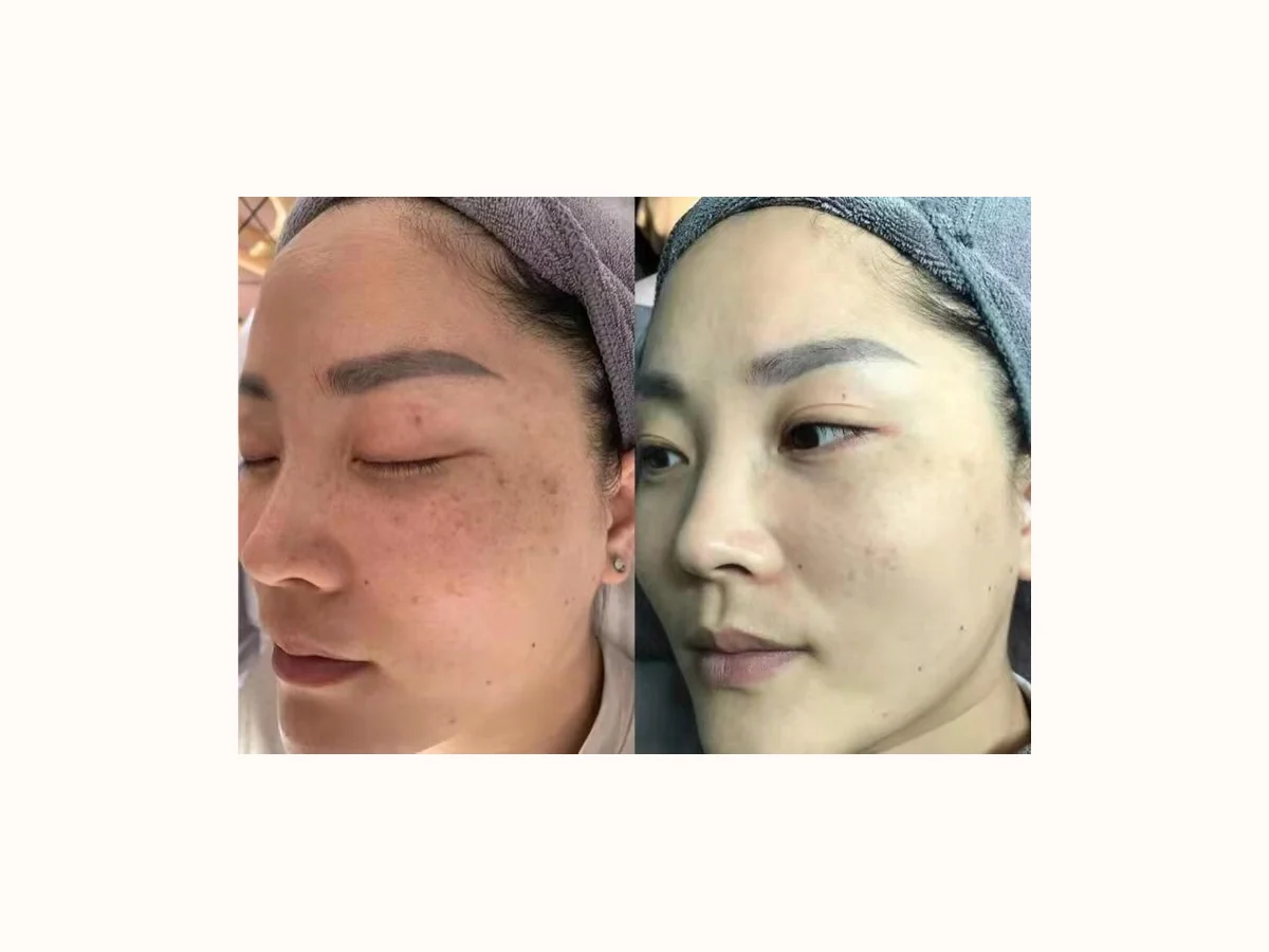 Pico Laser pigmentation before and after reference case 3
