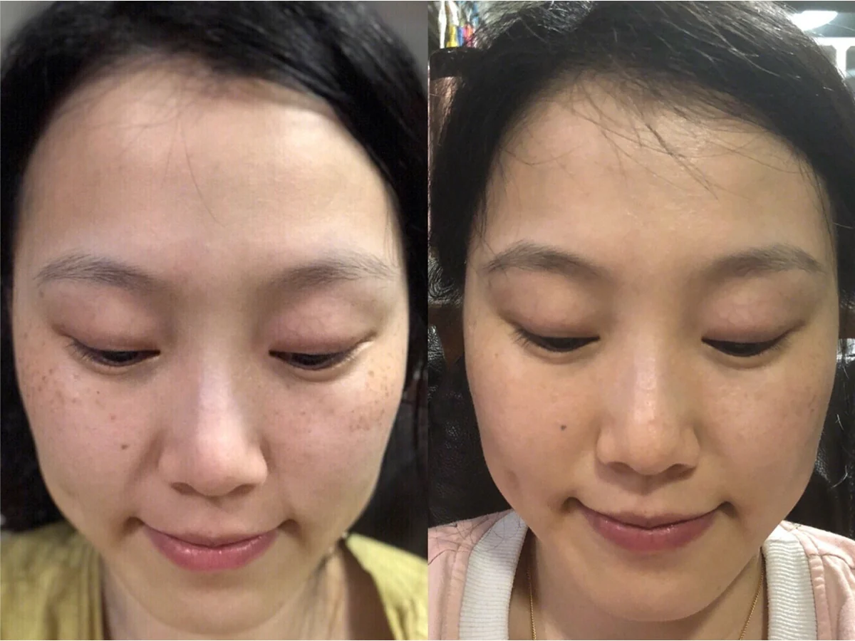 Pico Laser pigmentation before and after reference case 4