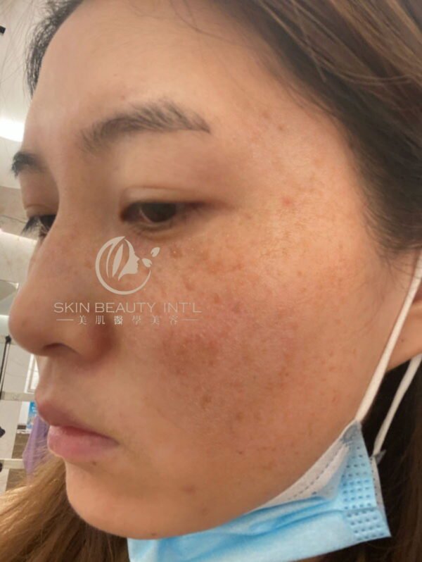 The Third Generation PICOsecond Laser - 图片 18